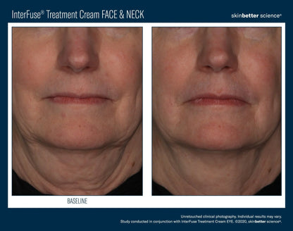 Interfuse Treatment Cream FACE & NECK